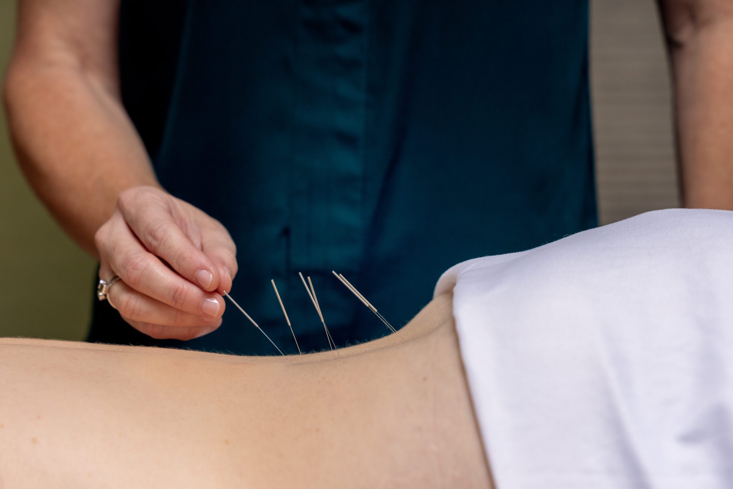 acupuncture in austin – A Touch of Therapy